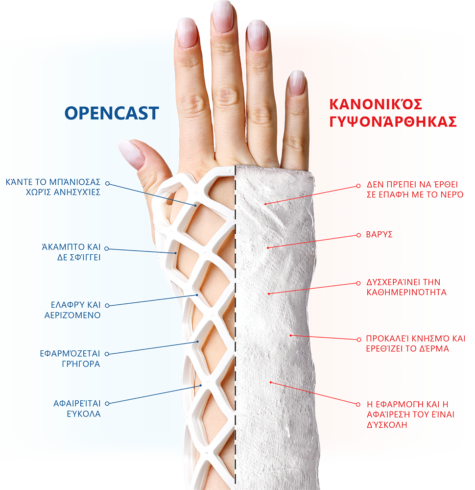 Běžná sádra vs OPEN CAST
